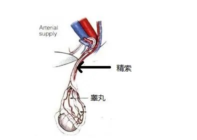 精索静脉曲张的表现