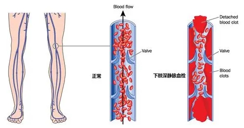 下肢静脉血栓