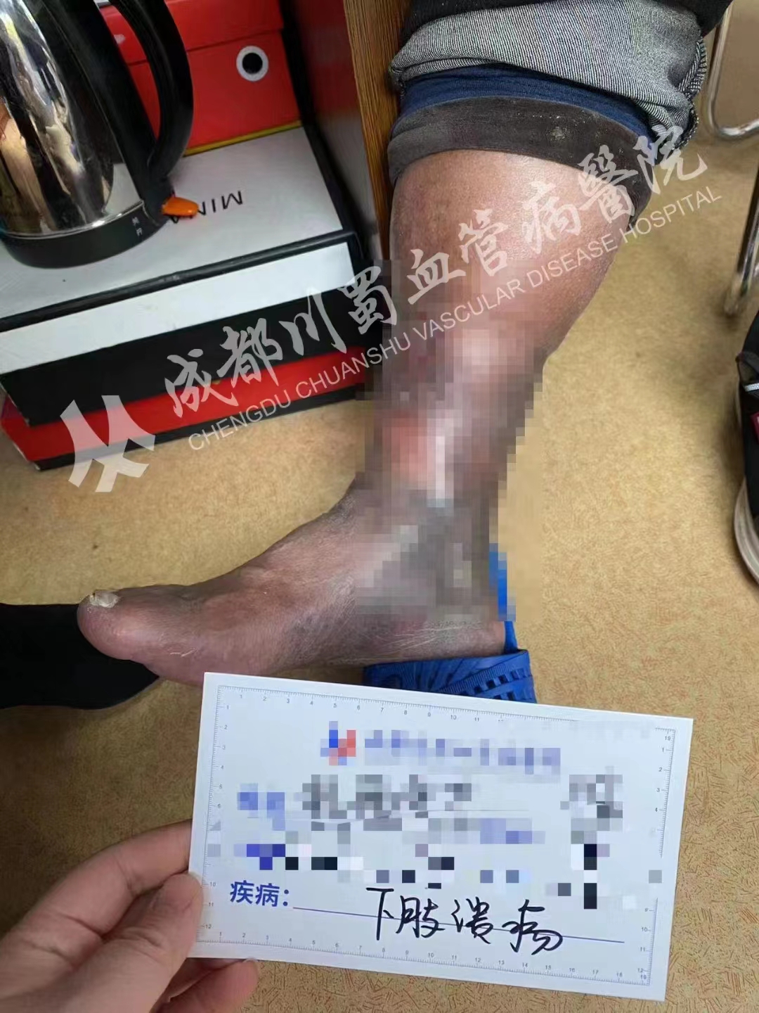 下肢静脉性溃烂