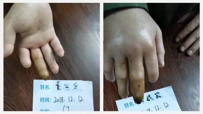 脉管炎1.JPG
