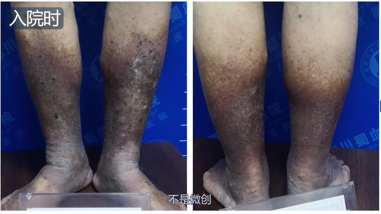 老烂腿