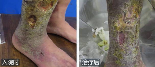 老烂腿.png