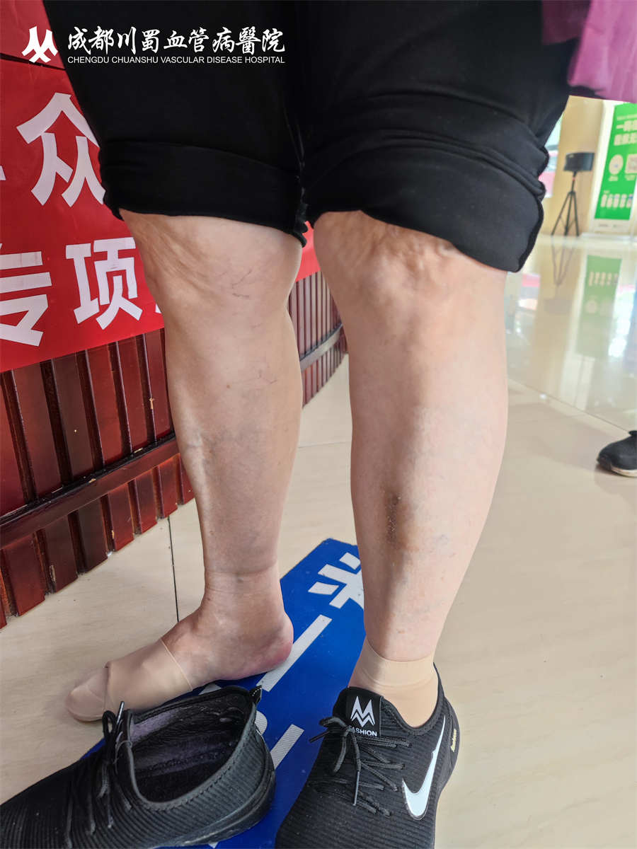 静脉曲张的治疗