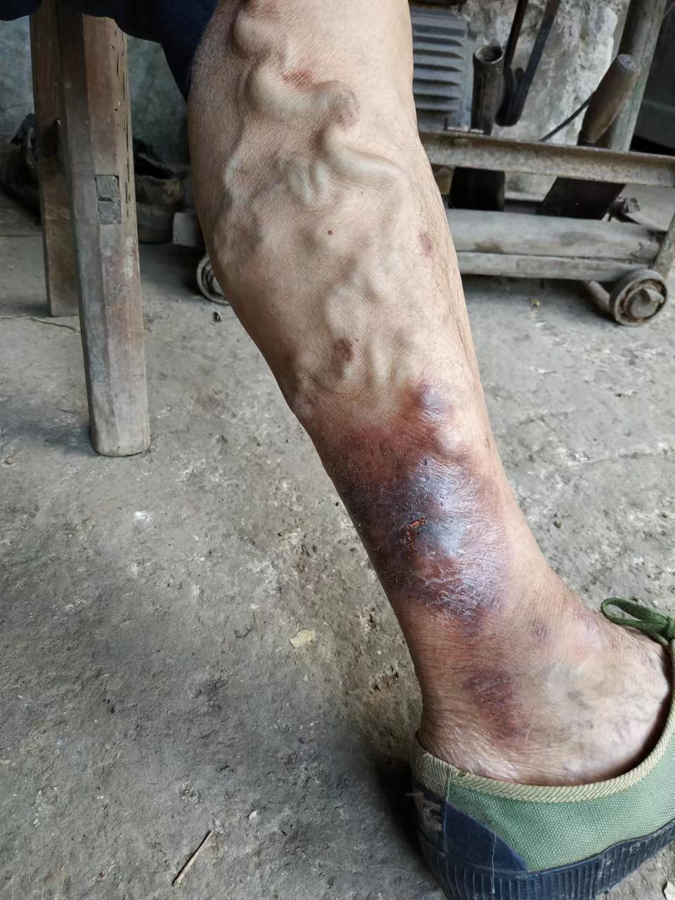 老烂腿