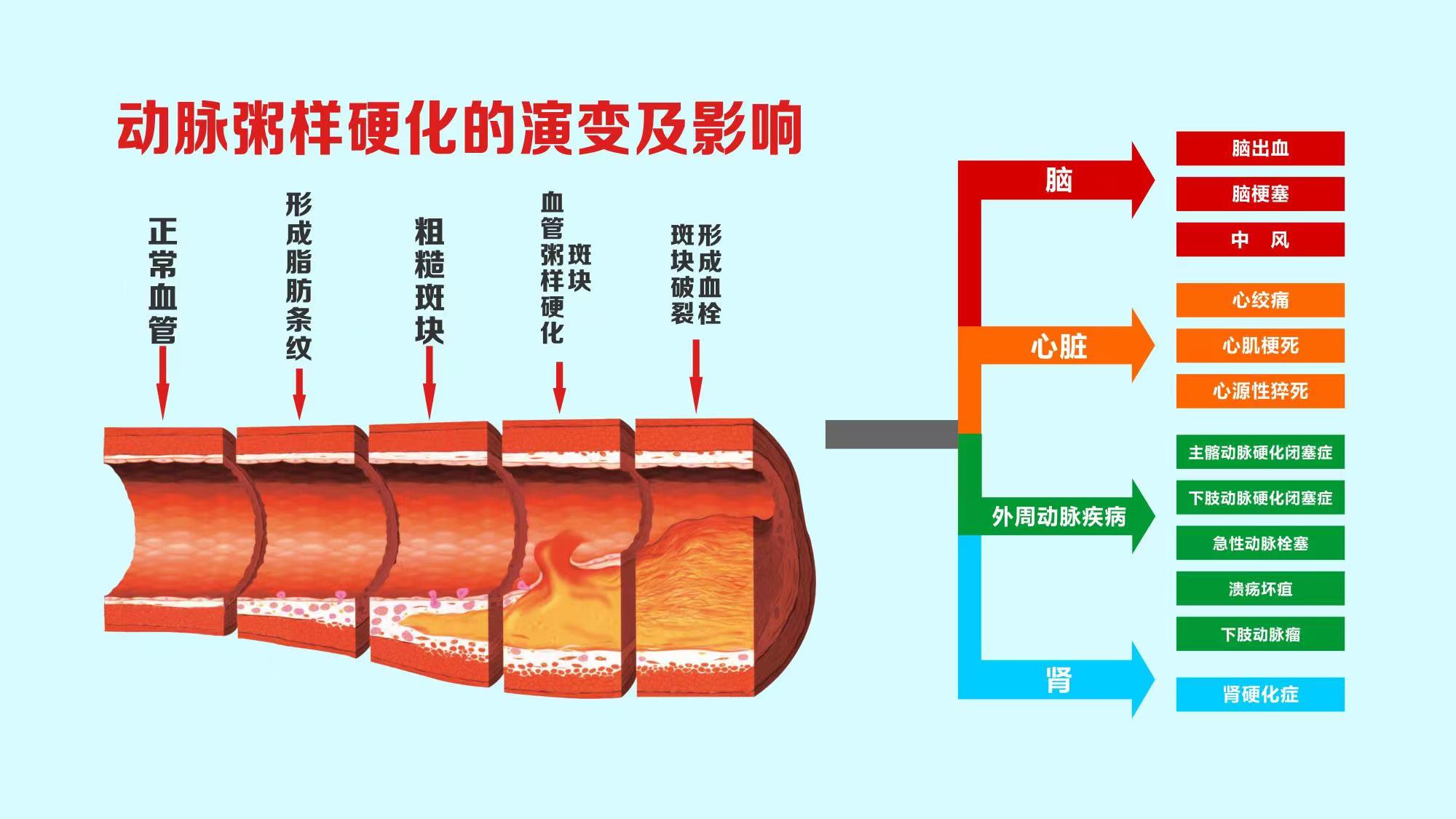 动脉硬化 