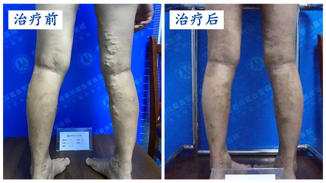 静脉曲张的症状