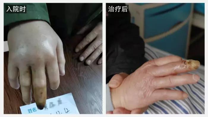 脉管炎2.JPG