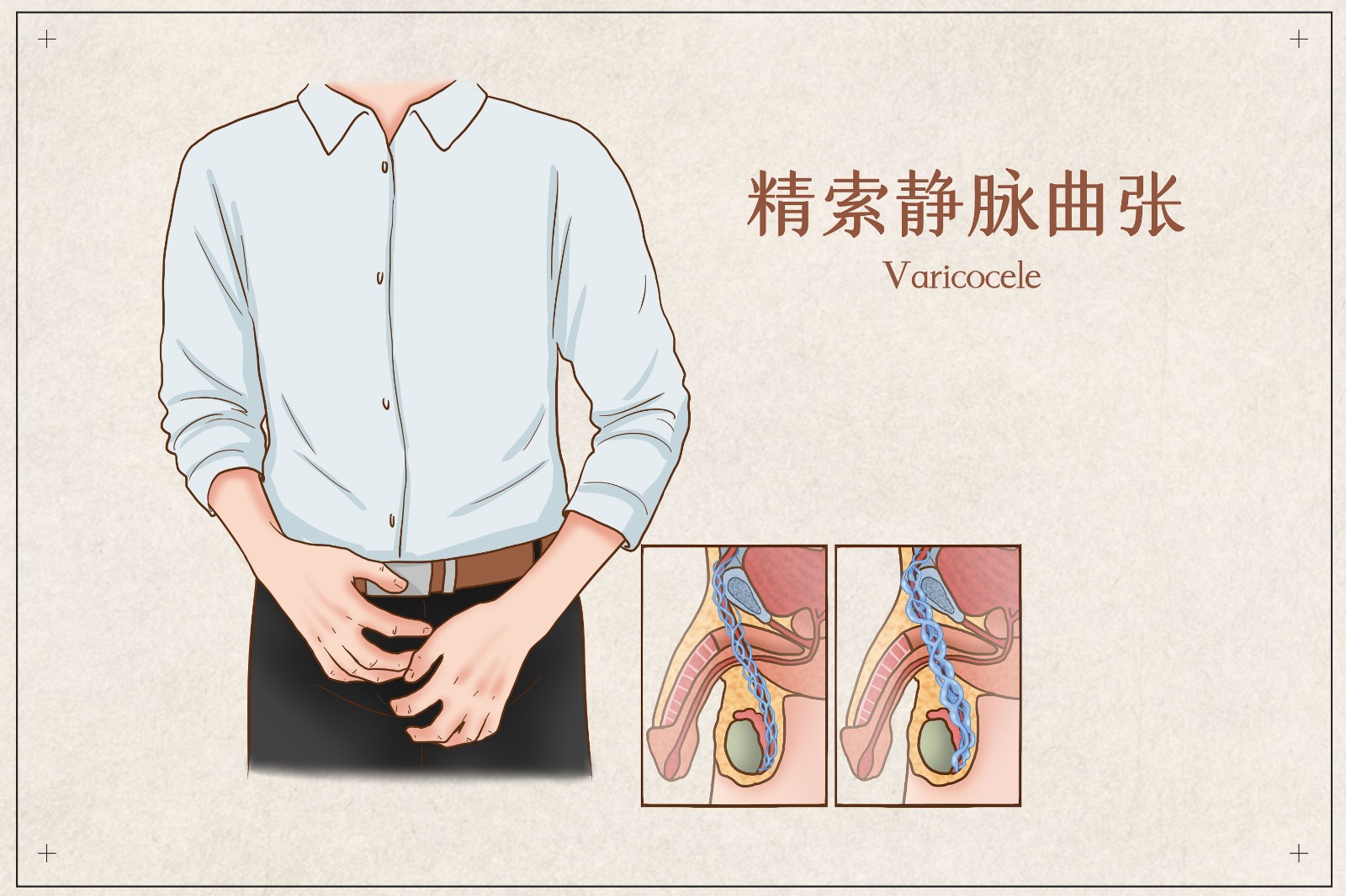 精索静脉曲张
