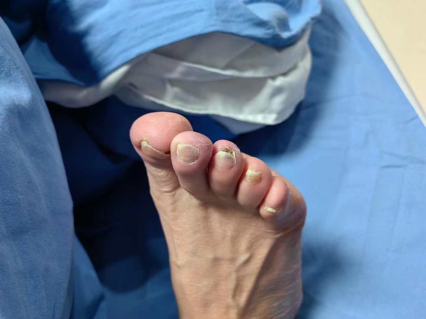 脉管炎